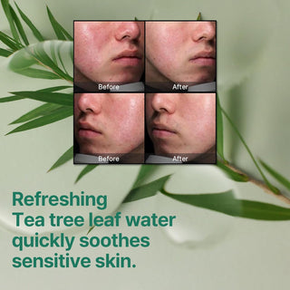SOMEBYMI Miracle Cream - resultats avant-apres sur peau sensible avec eau de tea tree apaisante