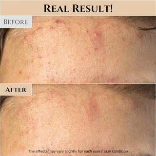 Resultat avant-apres sur peau a imperfections avec le Beauty of Joseon Masque Eclat Riz Fermente et Miel