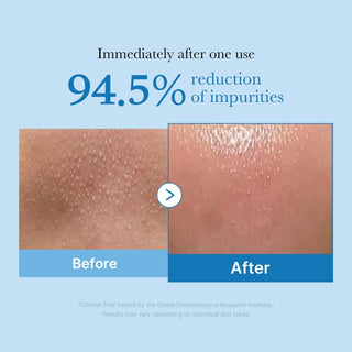 Resultat avant-apres Medicube Zero Pore Cleansing Oil avec 94.5% de reduction des impuretes