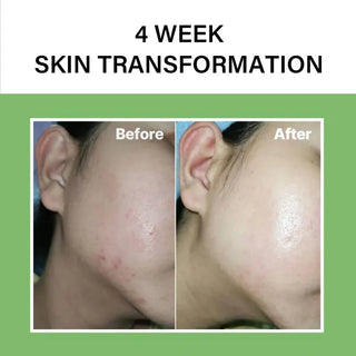 Celimax Noni Acne Bubble Cleanser - comparatif peau avant et apres 4 semaines sur fond vert