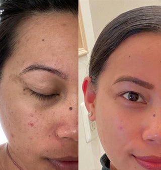 Resultat avant-apres teint avec le serum Medicube Deep Vita C Ampoule, peau plus uniforme